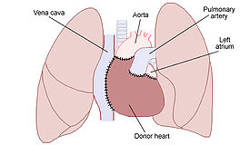 Organ bağışı neden önemlidir?